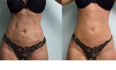 Фотона Боди 2